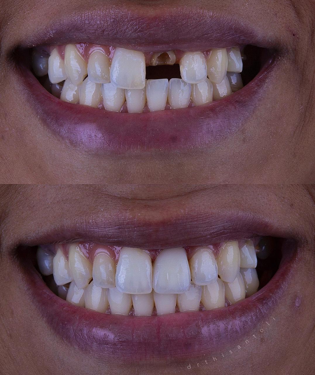Harmonização Facial