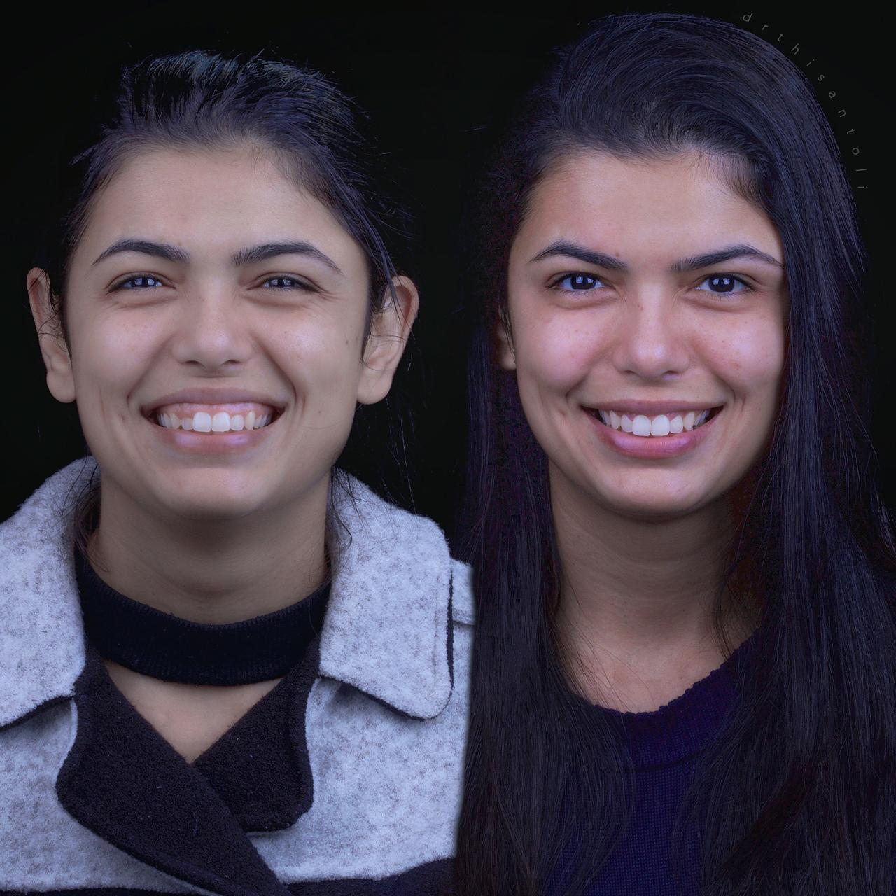 Alinhadores Transparentes